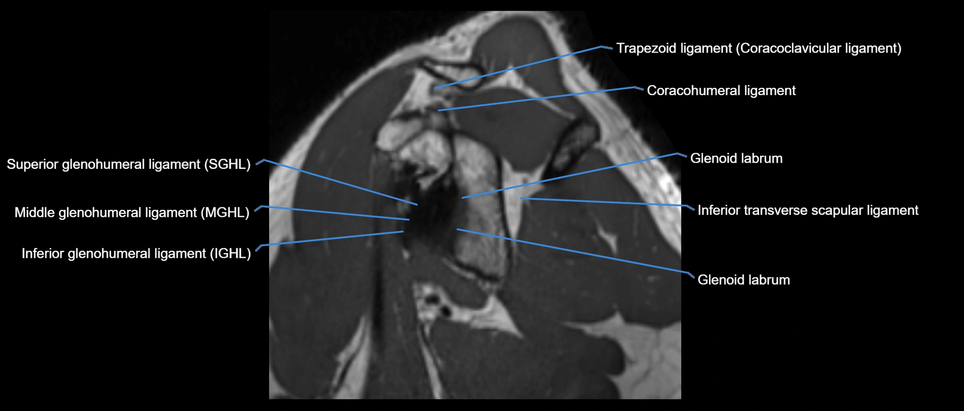 shoulder ligaments sagittal  cross sectional anatomy 3T MRI AI enhanced radiology image -img-00001-00023.webp